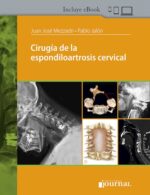 Cirugía de la espondiloartrosis cervical - Mezzadri