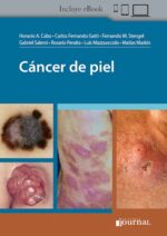 Cáncer de piel - Cabo