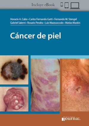 Cáncer de piel - Cabo